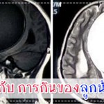 การป้องกันโรค