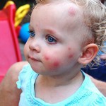 การป้องกันโรค