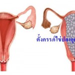 ตั้งครรภ์ไข่ปลาอุก โรคน่ากลัวของคนท้อง ดูแลครรภ์มารดา