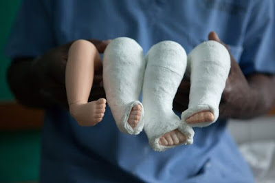 โรคเท้าปุก