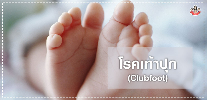 โรคเท้าปุก