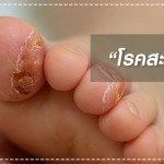 โรคสะเก็ดเงิน โรคผิดปกติทางพันธุกรรม ที่เกิดการอักเสบบนผิวหนังจนน่ากลัว สุขภาพลูกรัก