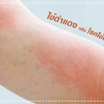 ไข้ดำแดง โรคติดต่อในเด็กที่คุณพ่อคุณแม่ไม่ควรมองข้าม สุขภาพลูกรัก